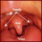 Tonsillitis